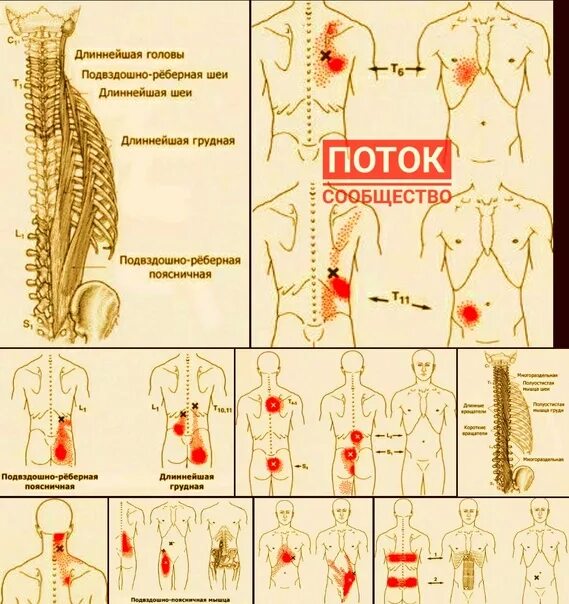 Триггерные точки поясницы. Триггеры поясницы. Карта триггерных точек поясницы. Триггеры мышц спины. Триггеры в мышцах.