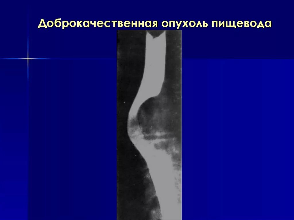 Киста пищевода. Опухоль пищевода рентген. Доброкачественные опухоли пищевода клинические рекомендации. Опухоли щевода рентген. Стеноз пищевода рентген.