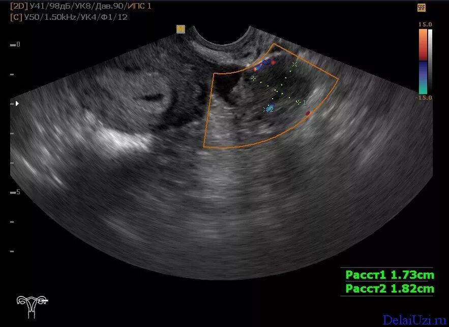 Желтое тело какие размеры. УЗИ яичников 4 фолликула. Желтое тело яичника по УЗИ.