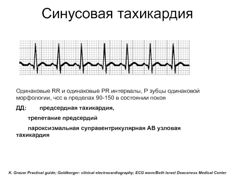 Синусовая тахикардия вертикальное. Синусовая тахикардия схема ЭКГ. Синусы тахикардия ЭКГ. Тахикардия ЧСС на ЭКГ. Синусовая тахикардия и норма на ЭКГ.