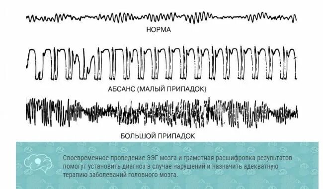 Зональные различия ээг. Ээг головного мозга расшифровка показателей. ээг мониторинг расшифровка. ээг головного мозга расшифровка показателей у взрослого. ээг головного мозга ребенка расшифровка показателей норма.
