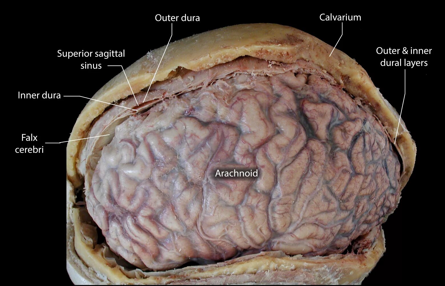Паутинная оболочка головного мозга анатомия. Паутинная оболочкагооловного мозга. Паутинная оболочка головного мозга препарат. Мягкая мозговая оболочка. Поражение оболочек мозга