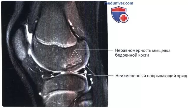 Перелом мыщелка бедренной кости на мрт. Остеохондропатия мыщелка бедренной кости мрт. Импрессионный перелом мыщелка бедренной кости коленного сустава. Асептический некроз медиального мыщелка. Некроз мыщелка бедренной