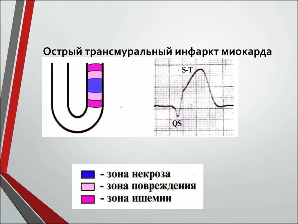 Трансмуральный инфаркт лечение. Трансмуральный инфаркт миокарда. трансмуральное повреждение миокарда. острый трансмуральный инфаркт. при трансмуральном инфаркте миокарда зона некроза.