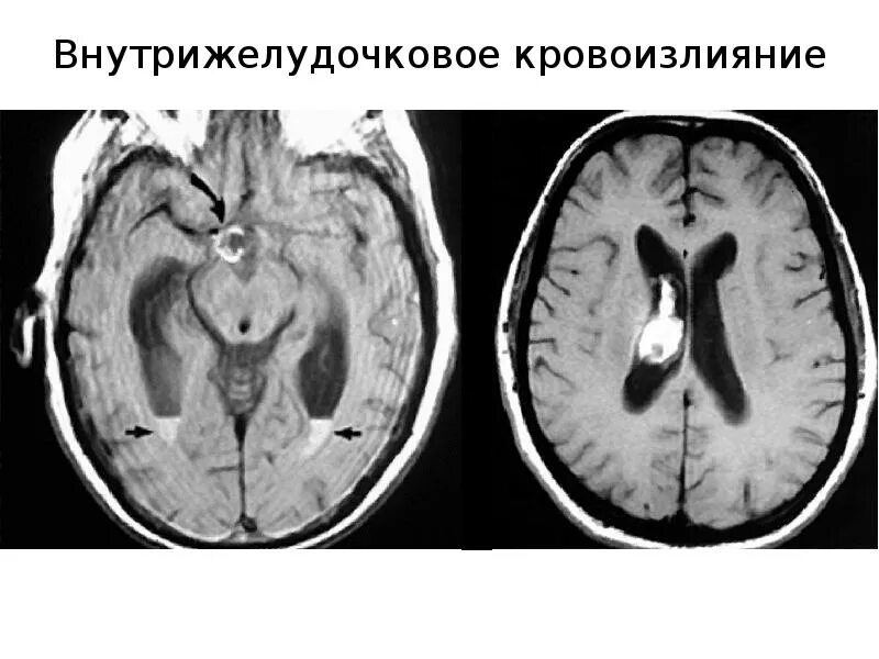 Кровоизлияние в мозг у новорожденного степени. Внутрижелудочковые кровоизлияния мрт. геморрагический субарахноидальный инсульт. субарахноидальное кровоизлияние макро. инсульт субарахноидальное кровоизлияние головного.