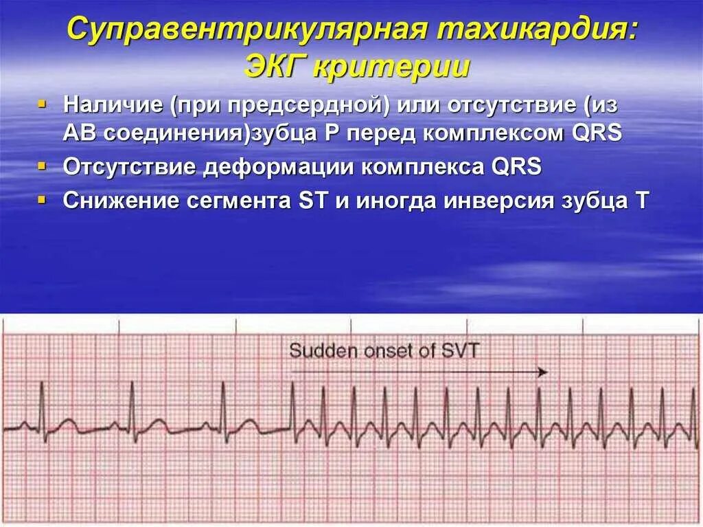 Сердцебиения 27. ЭКГ критерии пароксизмальной суправентрикулярной тахикардии. Пароксизмальная наджелудочковая тахикардия ЭКГ. Суправентрикулярная тахикардия (свт) ЭКГ. Пароксизмальная желудочковая тахикардия на ЭКГ.