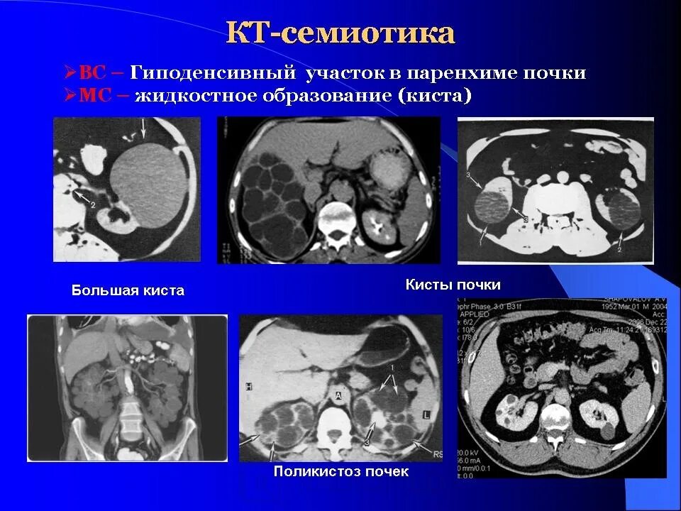 Образования печени кт. Гиперденсные образования почек на кт. Гиперденсивная киста почки на кт. Гиподенсные образования в печени что это такое на кт. Гиподенсное образование в почке на кт что это.