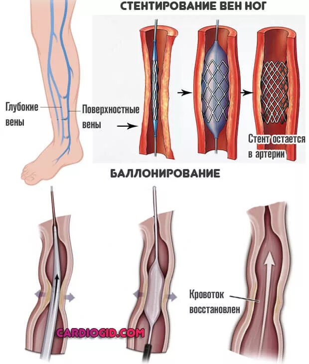 Стентирование сосудов конечностей. Стентирование атеросклерозе артерий конечностей. Стентирование сосудов эндоваскулярное. Стентирование вен нижних конечностей. Удаление тромба цена