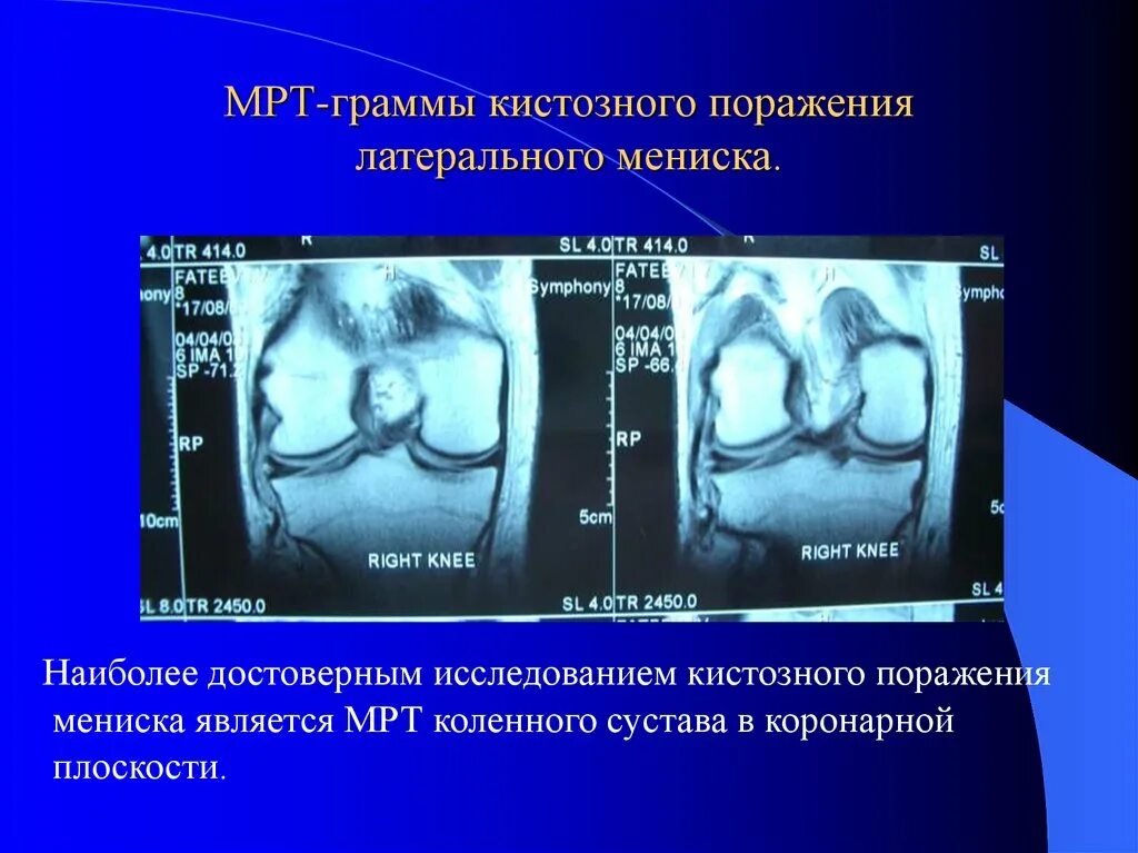 Повреждение латерального мениска коленного сустава мрт. Мрт коленного сустава разрыв мениска. Травма мениска коленного сустава мрт.