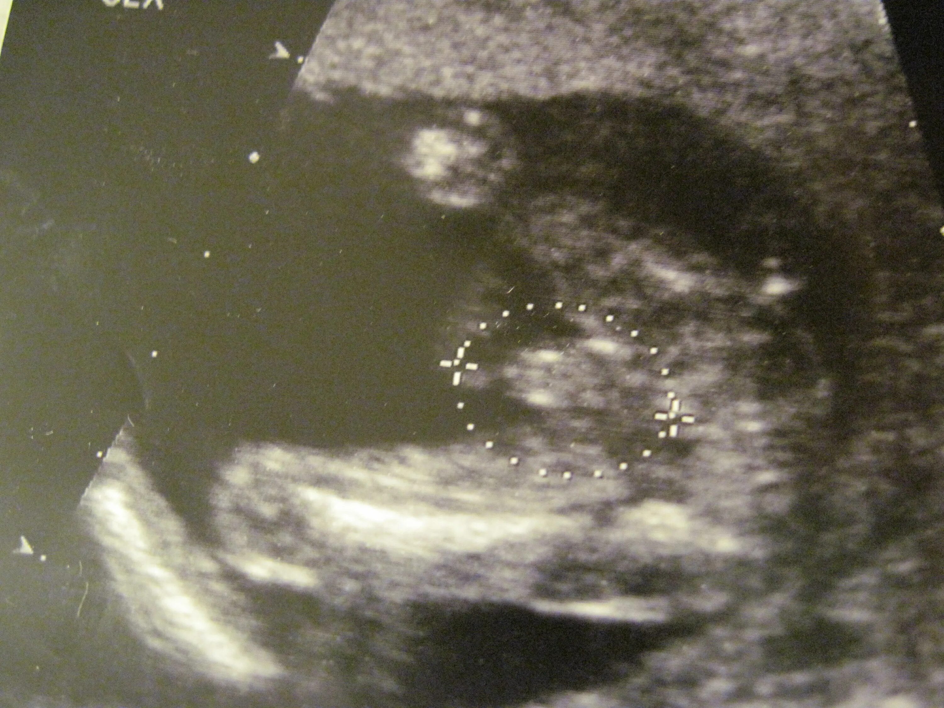 УЗИ ребенка на 15 неделе беременности. Снимок УЗИ на 16 неделе беременности.