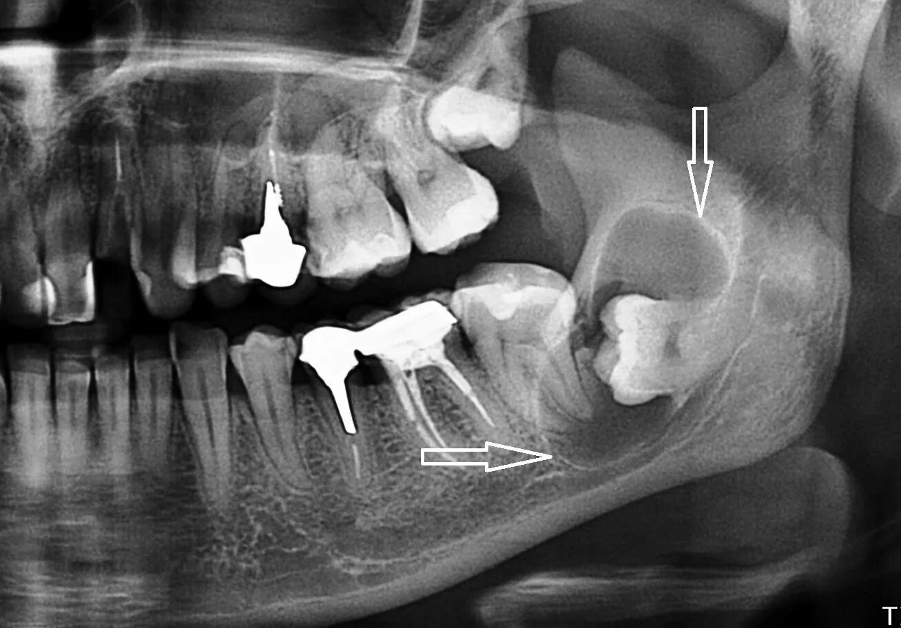 Зуб 8 нижний. Ретинированный зуб мудрости. Ротироваррый зуб мудрости. Ретинированный зуб мудрости снимок.