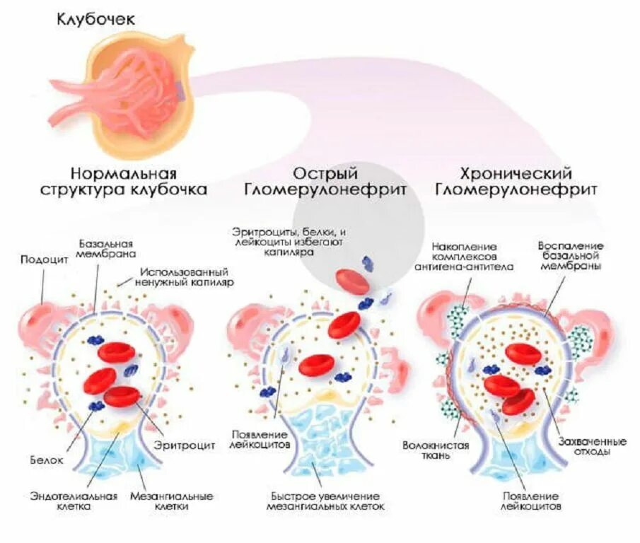 Механизм развития хронического гломерулонефрита. Острый подострый хронический гломерулонефрит. Патогенез острого гломерулонефрита картинки. Поражение клубочков гломерулонефрит. Поражение клубочков почек