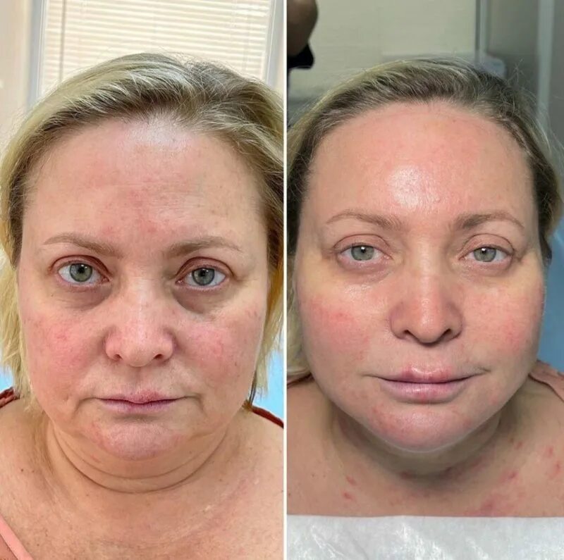Инъекции после 30. Инъекции красоты до и после. Лицо до и после косметолога.