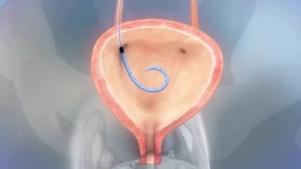 Контактная литотрипсия камней мочевого пузыря, мочеточника. Как снимают стент. Как снимают стент. Стенд катетер для мочеточника. Эндоскопическая уретеролитотрипсия.