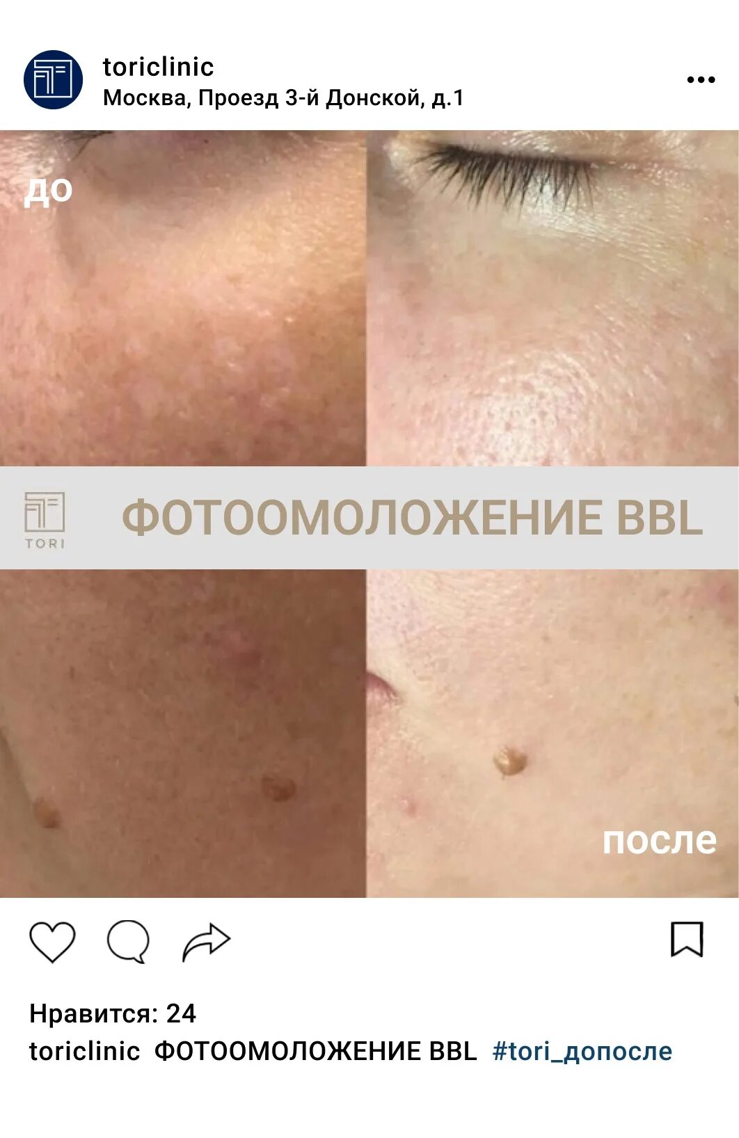 Bbl процедура москва. Bbl процедура москва. Результат сразу после процедуры bbl forever young. Bbl процедура москва. Фотоомоложение проблемной кожи.
