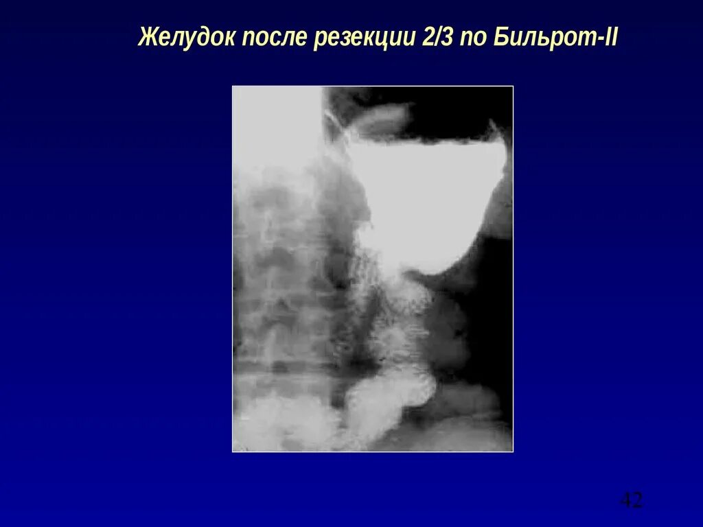 Рентгеноскопия желудка по Бильрот 1 рентген. Рентген желудок по Бильрот 2. Резекция желудка рентген. Желудок после резекции.