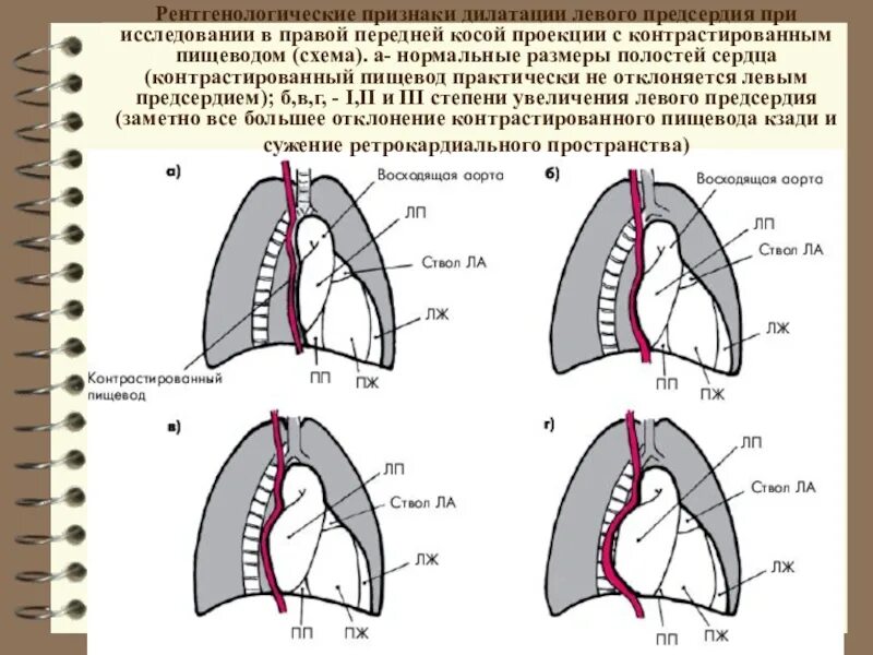 Размеры полостей сердца. Левая косая проекция сердца на рентгенограмме. левая передняя косая проекция. правая косая проекция сердца. сердце на рентгенограмме проекции косые.