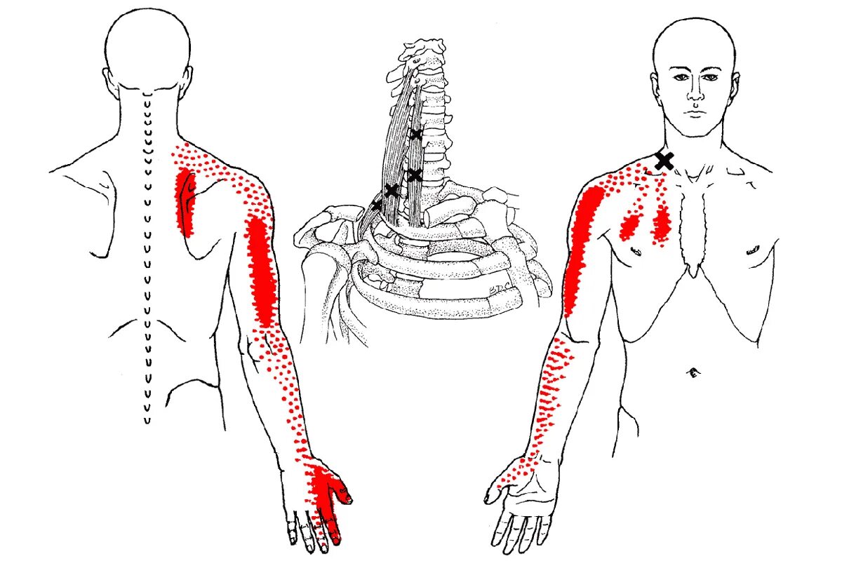 Болит правая лопатка и отдает в руку. Триггерные точки зубчатой мышцы. Триггерные точки плеча и шеи. Триггерные точки мышц шеи. Лестничные мышцы триггерные точки.