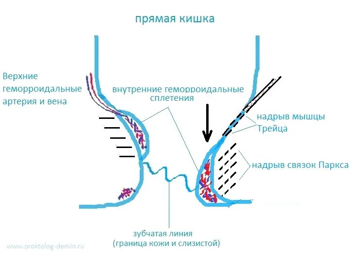 Прямая кишка анатомия строение геморрой. Кавернозные вены прямой кишки. Гистология геморройного узла. Узлы в прямом кишечнике.