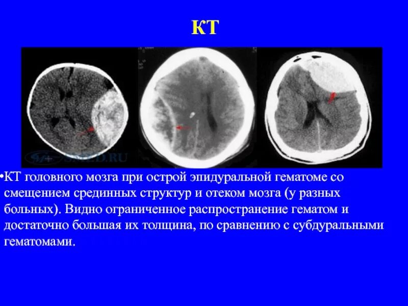 Черепно мозговые гематомы. Субдуральная и эпидуральная гематома. Эпидуральная гематома головного мозга на кт. Эпидуральная гематома на кт. Субдуральная и эпидуральная гематома на УЗИ.