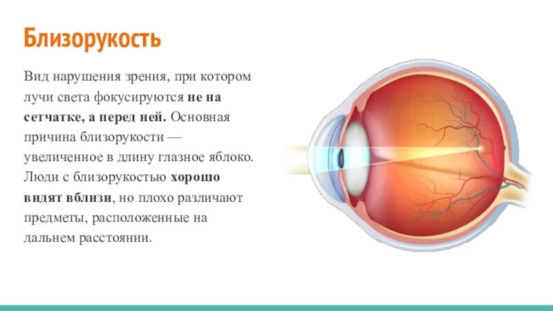 Таблица заболевания глаз близорукость и дальнозоркость. Близорукость сообщение по биологии. Причины нарушения зрения близорукость дальнозоркость. Причины развития близорукости и дальнозоркости. Болезнь дальнозоркость