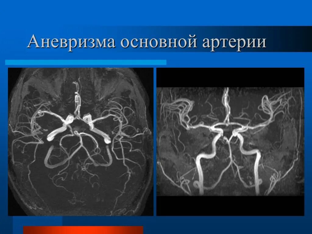 Аневризма артерии головного мозга. Аневризма мозговых артерий кт. бесконтрастная ангиография. аневризма передней соединительной артерии головного мозга мрт. аневризма бифуркации основной артерии.