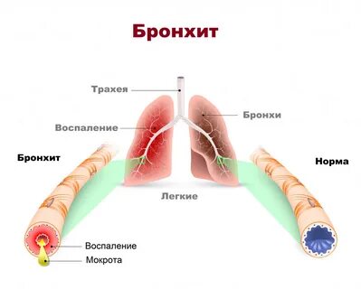 Трахеи без кашля