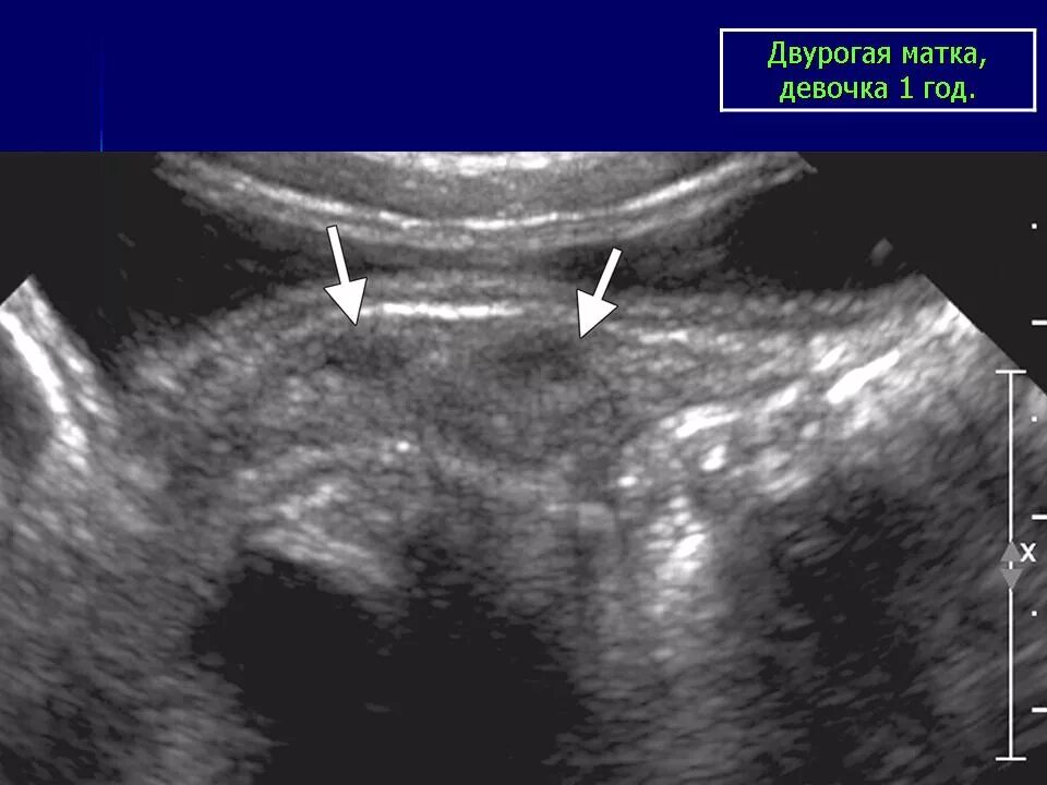 Двурогая седловидная матка. Двурогая и седловидная матки на УЗИ. УЗИ картина двурогой матки. Что такое двурогая матка