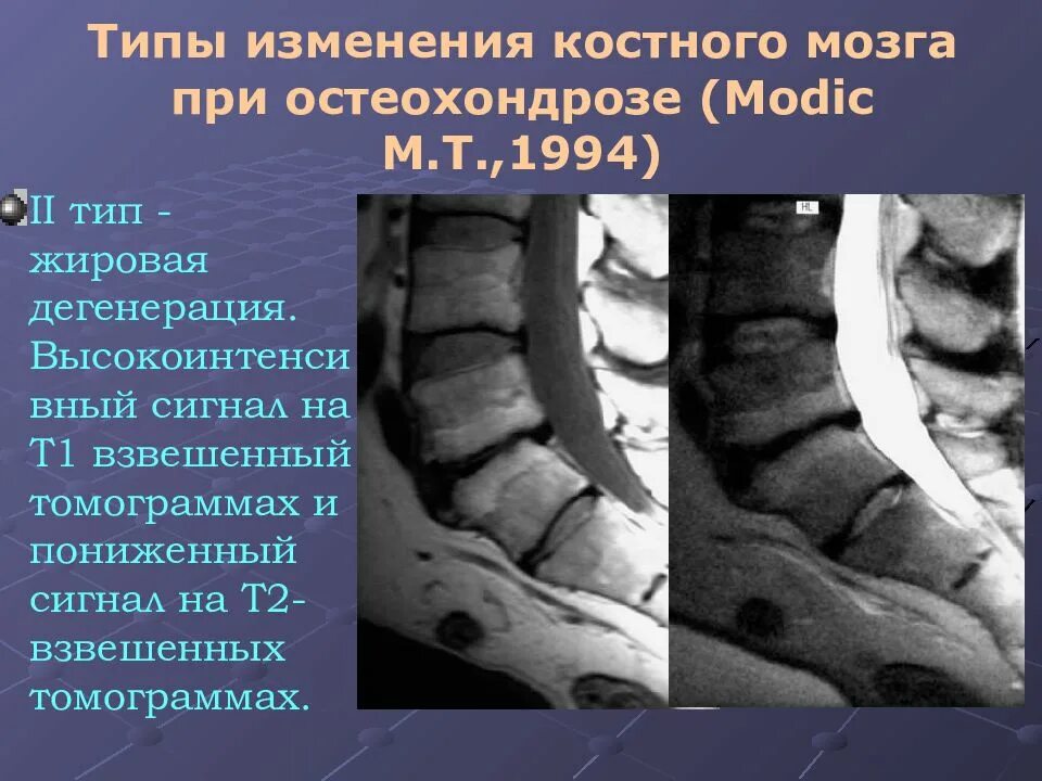 Жировой перестройки. Очаги жировой дегенерации костного мозга Modic 2. Липоидная дегенерация костного мозга позвоночника. Жировая дистрофия костного мозга в телах позвонков. Жировая перестройка тел позвонков.