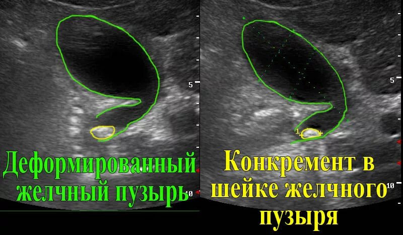 S образный желчный пузырь УЗИ. Шейка желчного пузыря на УЗИ. S образная деформация желчного пузыря. S образный Перегиб желчного пузыря. Натощак желчный пузырь