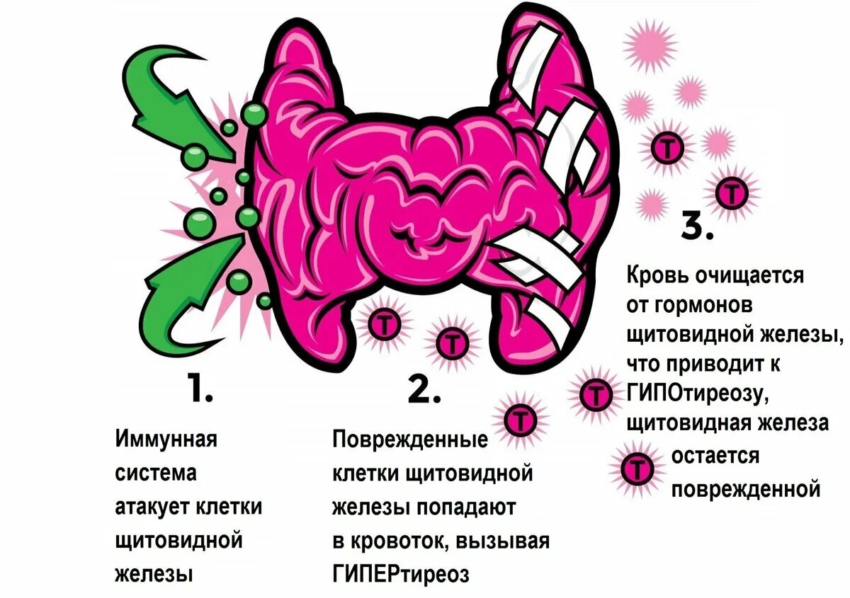 Аутоиммунный зоб. Аутоиммунный зоб Хашимото патогенез. Щитовидная железа болезнь Хашимото. Аутоиммунный гипотиреоз патогенез. Хронический аутоиммунный тиреоидит патогенез.