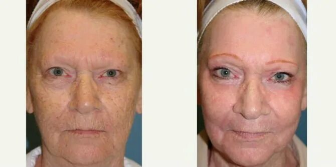 Газожидкостный пилинг jet peel. Bb glow процедура для лица. Газожидкостный пилинг до и после. Барофорез скиндекс. Газожидкостный пилинг лица.