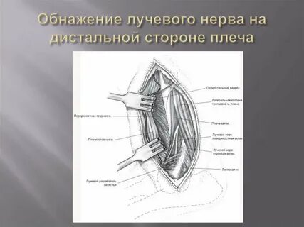Лучевой нерв на плече