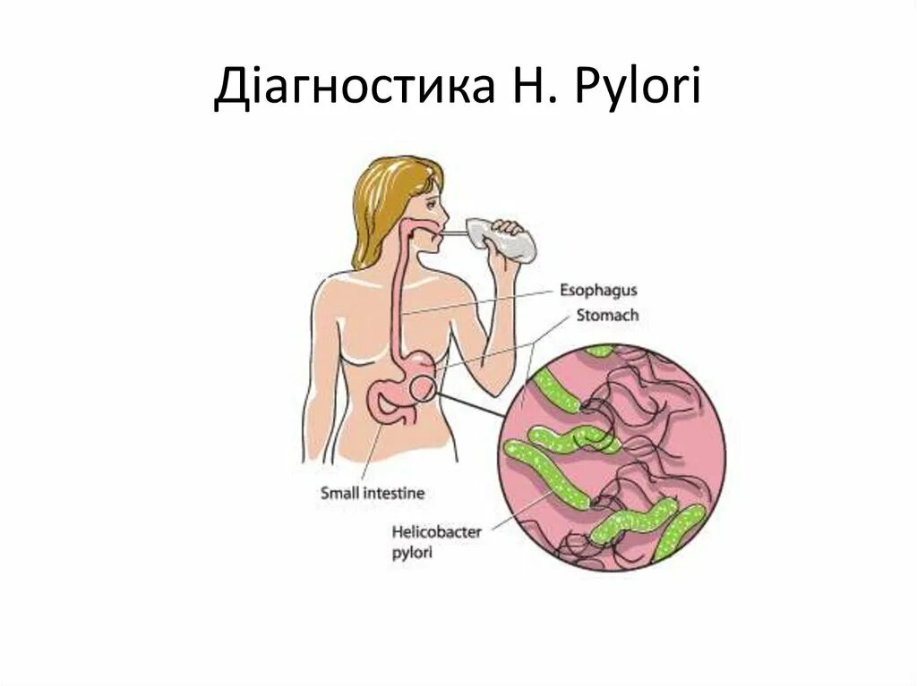 Тест на хеликобактер пилори дыхательный как проводится. Дыхательный тест для определения h.pylori;. 13с-уреазный дыхательный тест заключение. Helicobacter pylori дыхательный тест. Диагностика инфекции Helicobacter pylori.