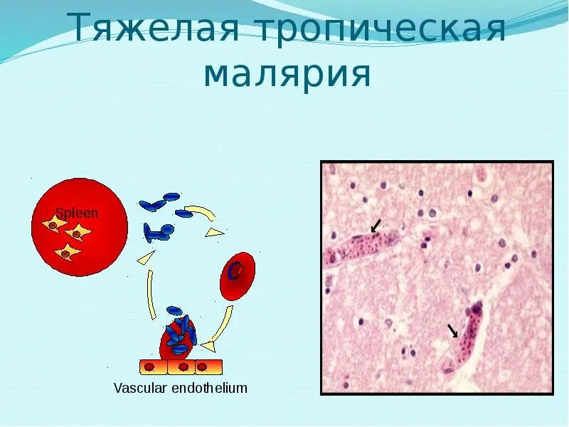 Тяжелое течение малярии возбудитель. Возбудитель тропической малярии. Тропическая малярия степени тяжести.