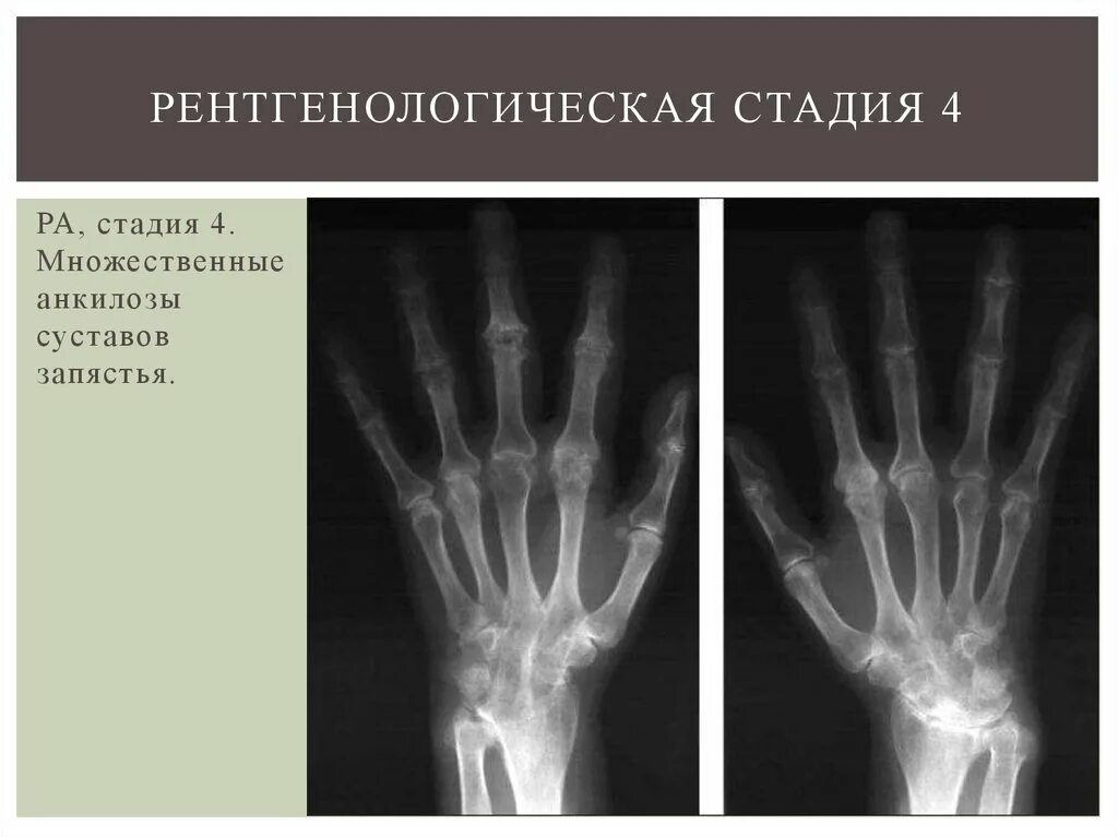 Артрит рентгенологические стадии. Анкилоз ревматоидный артрит рентген. Рентген стадии ревматоидного артрита по Штейнброкеру. Анкилоз суставов кисти рентген.