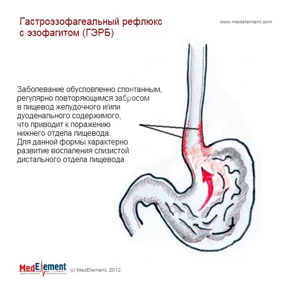 Снять рефлюкс. Гастро эзофагит рефлюкс. Гастроэзофагеальная рефлюксная болезнь с эзофагитом. Хронический неэрозивный рефлюкс эзофагит. Кандидозный рефлюкс эзофагит симптомы.