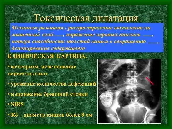 Как лечить дилатацию