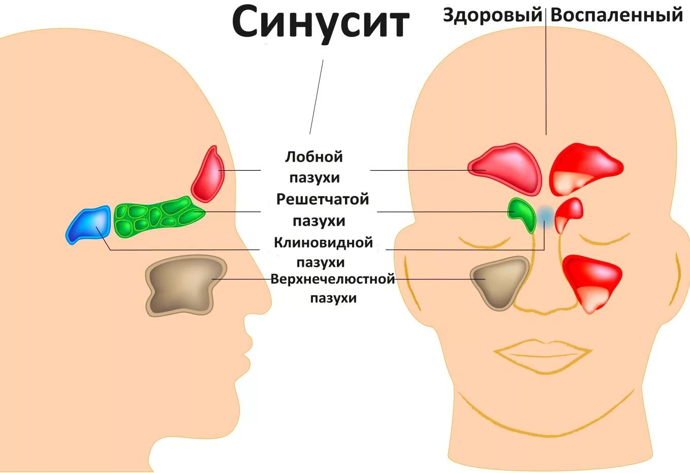 Скрип в голове. Синусит лобной пазухи фронтит. Острый сфеноидальный синусит. Острые и хронические синуситы. Фронтит гайморит пазухи.