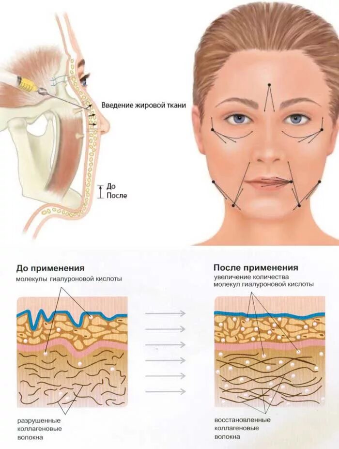 Нития инъекции