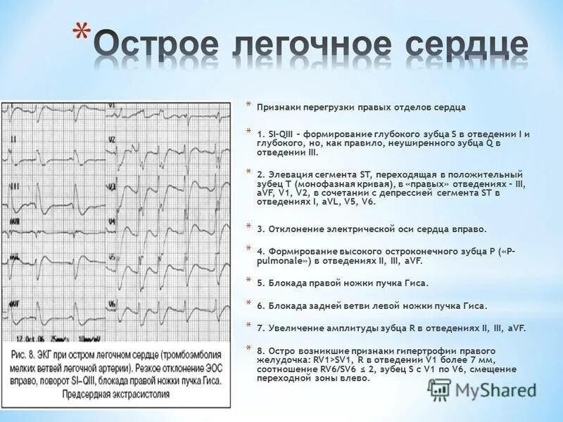 Неспецифические изменения нижней стенки. Отрицательные зубцы т на ЭКГ В v2 v5. Отрицательный зубец т на ЭКГ 1 AVL. Отрицательный зубец т в 1 и AVL v5 v6. Отрицательный зубец т на ЭКГ В 1 АВЛ отведениях.