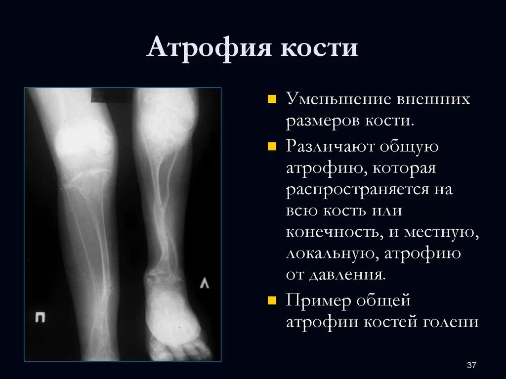 Атрофия костей и суставов. Проявления общей атрофии. Атрофия латынь