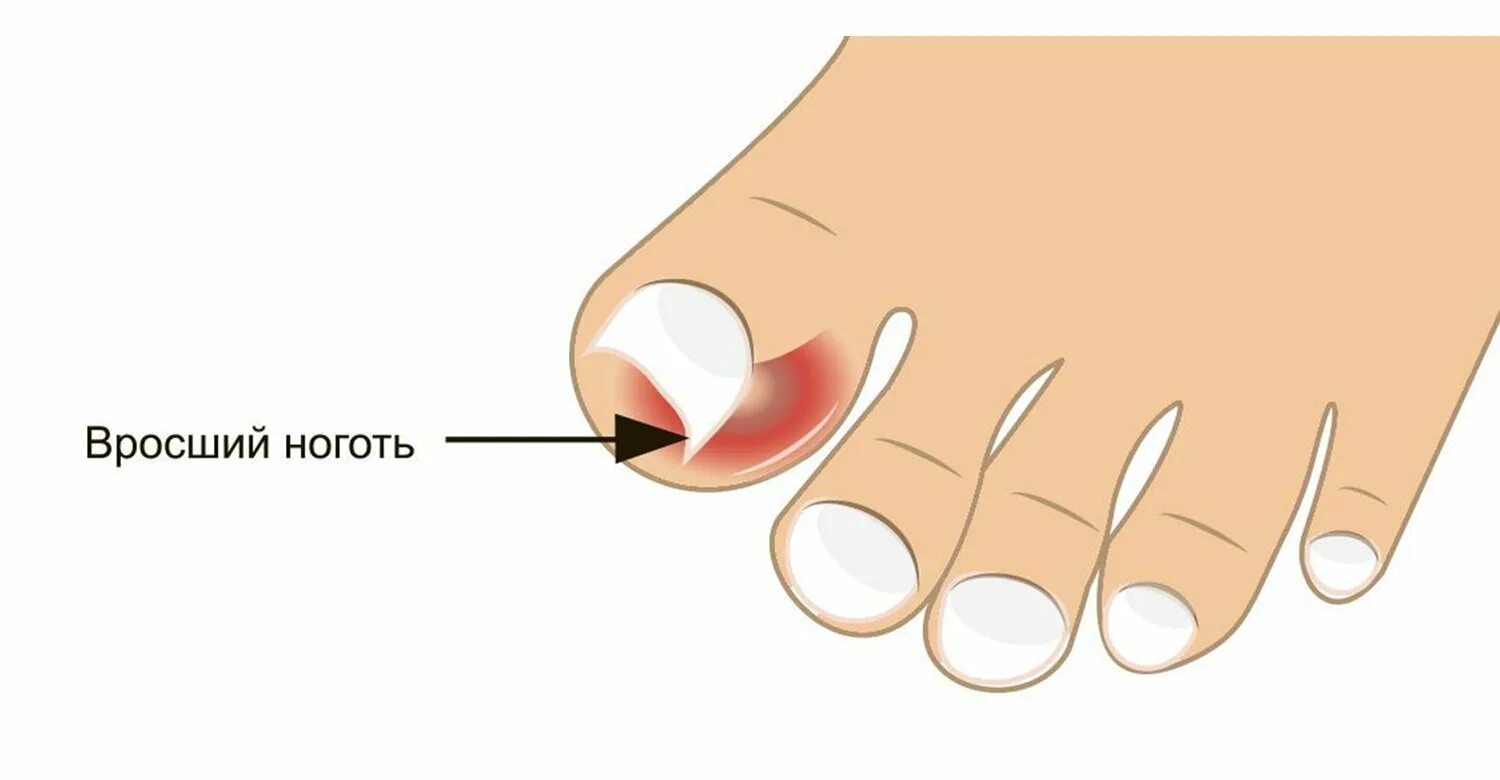 Ногтевой валик на ноге. Врошийся ноготь на ноге.