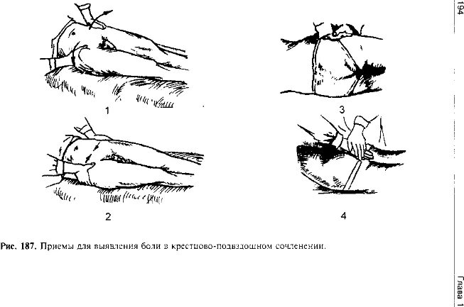 Сакроилеит крестцово-подвздошного сочленения. Блокада крестцово подвздошного сочленения. Бруцеллезный сакроилеит. Блокада крестцово подвздошного сочленения. Блокада крестцово-подвздошного сочленени.
