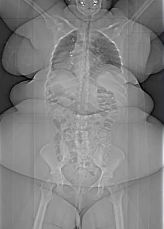 Широкая кость. Рентген Толстого человека.