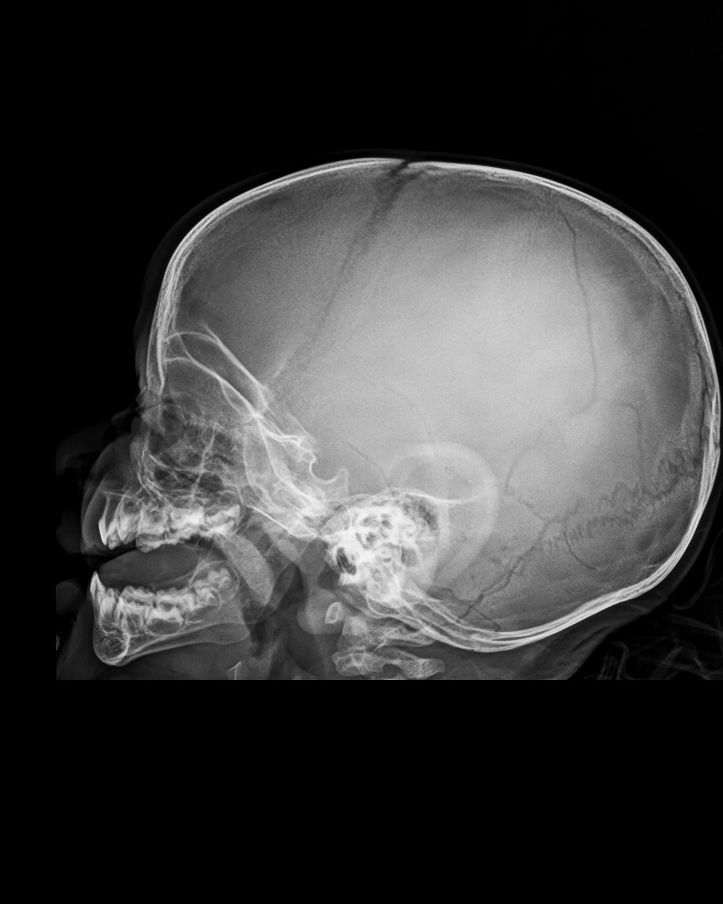 Трещина в голове. Кости черепа рентген норма. Череп новорожденного рентген норма. Рентген головы ребенка 1 год. Кости черепа ребенка рентген анатомия.