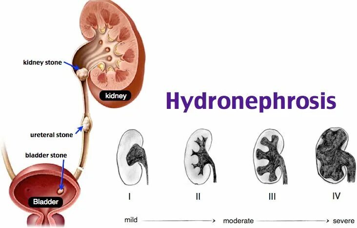 Заболевание почек гидронефроз. Гидронефроз 2-3 степени. Степени гидронефроза на кт. Гидронефроз почки УЗИ. Гидронефротическая трансформация почки степени.