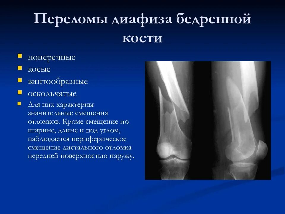 Укорочение трубчатых. Перелом нижней трети диафиза правой бедренной кости. Симптоматика перелома кости. Эпифизарные переломы кости. Клиника диафизарного перелома бедренной кости.