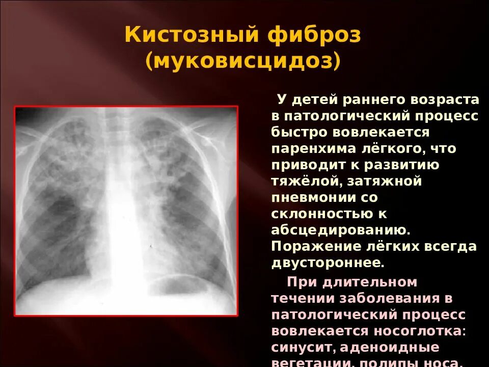 Муковисцидоз бронхолегочная форма. Муковисцидоза кистозный фиброз.