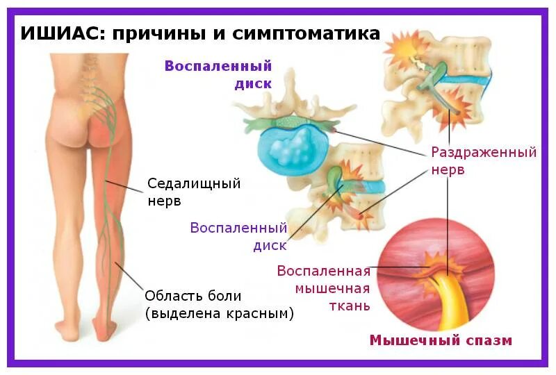 Болят ягодицы от уколов